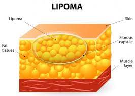 Lipóma – zsírdaganat